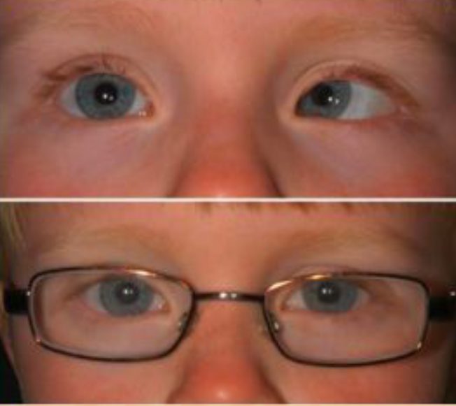 علاج الحول بالنظارات